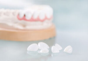 Dental Crowns That Keep Your Teeth and Gums From Graying
