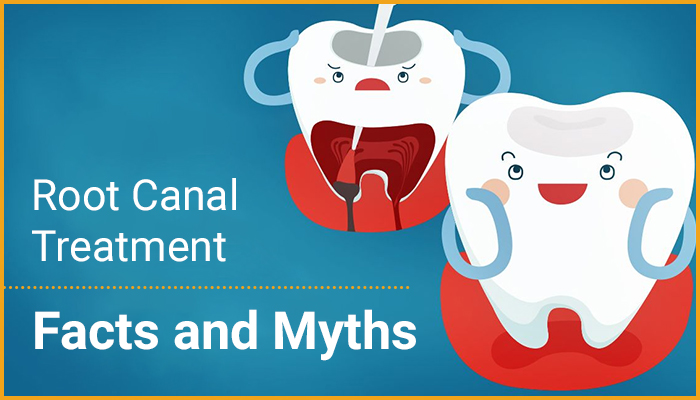 Blog RootCanal 2