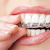service invisalign dentist